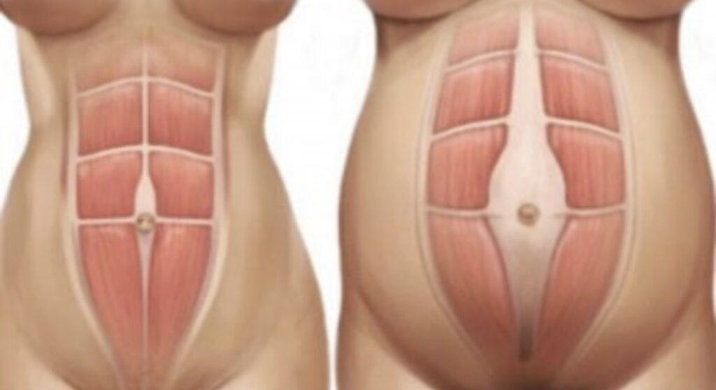 Strength training for Diastasis Recti Support