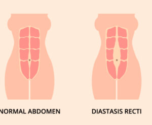 Postnatal Personal Training For Diastasis Recti Support